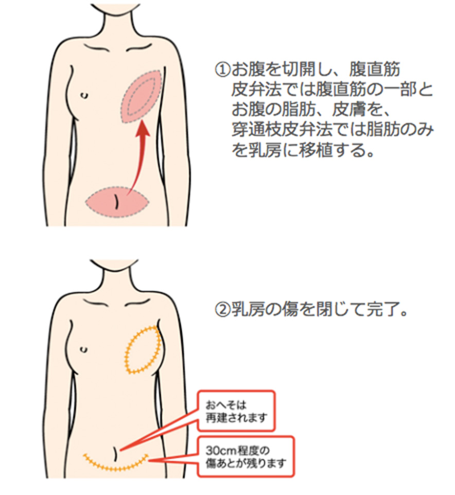 乳腺専門外来 - 当院は乳房再建の認定施設です │ 診療科・専門外来